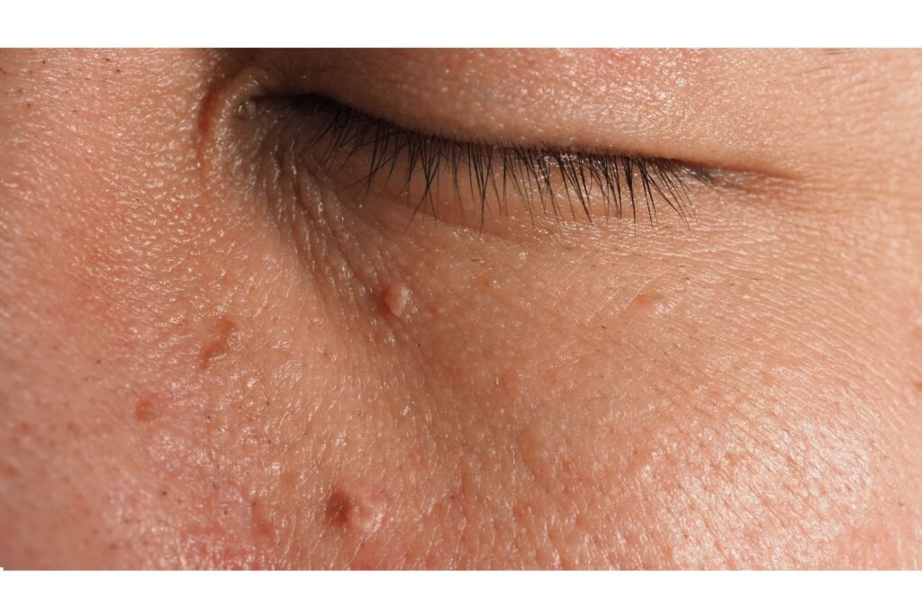 Verrugas perto do olho.