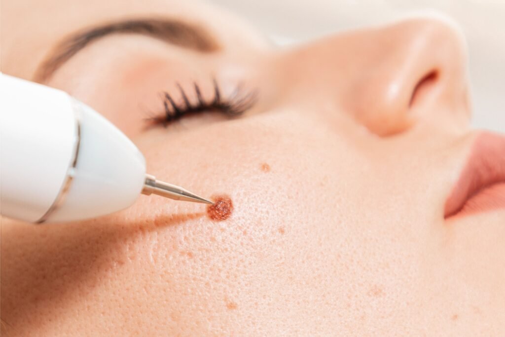 Mulher retirando verruga.