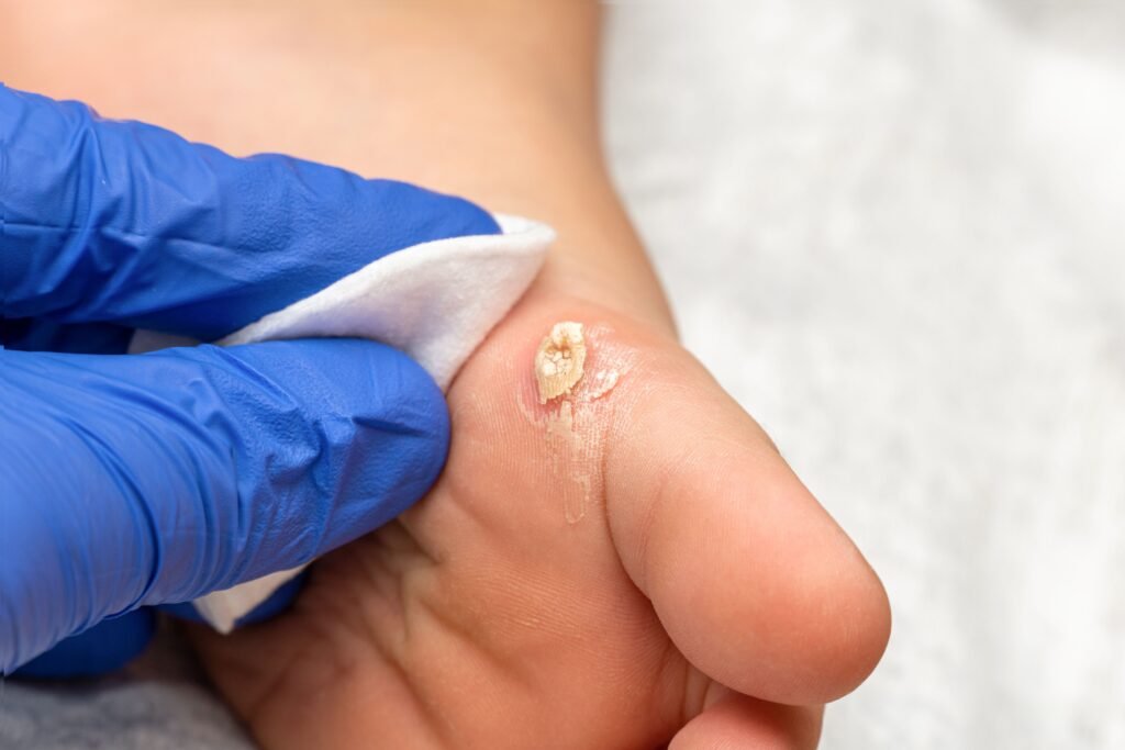 Verruga no pé sendo retirada. 