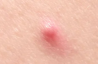 Sonhar com furúnculo: na perna, no braço, no rosto, nas costas e mais!