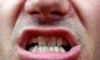 O que significa sonhar com dente sujo? Preto, amarelo, de feijão e mais!