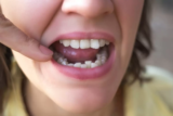 Sonhar com dente torto: mole, com aparelho, nascendo torto e mais!