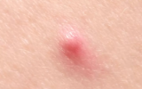 Sonhar com furúnculo: na perna, no braço, no rosto, nas costas e mais!