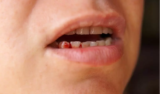 O que significa sonhar com dente sangrando? Quebrado, podre e mais